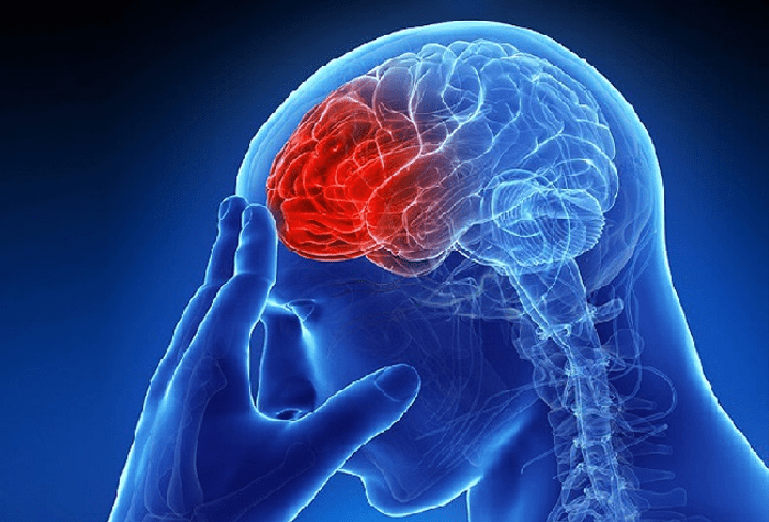  Stroke