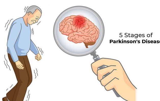 بیماری پارکینسون